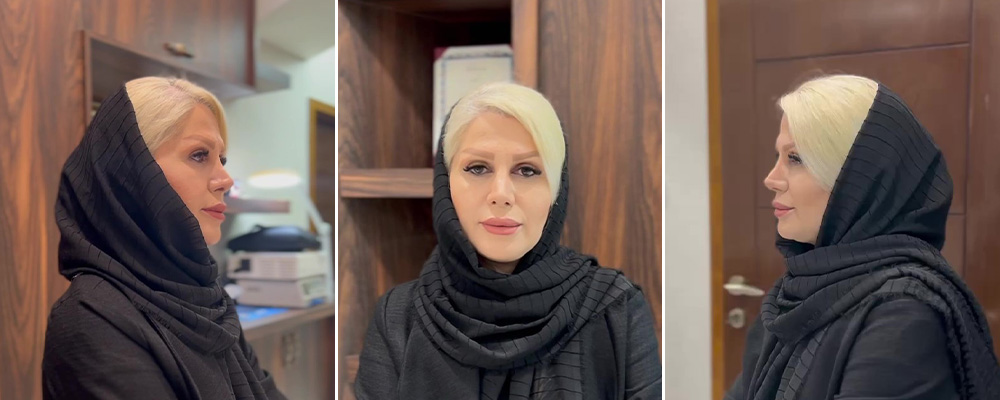 نتیجه عمل بینی دکتر شبنم حاجی علیپور بهترین جراح بینی تبریز
