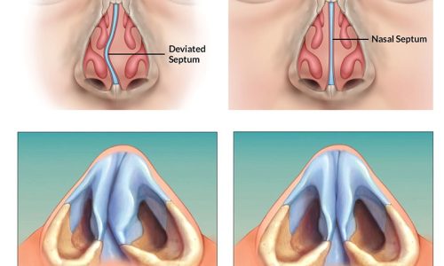 Rhinoplasty in Tabriz